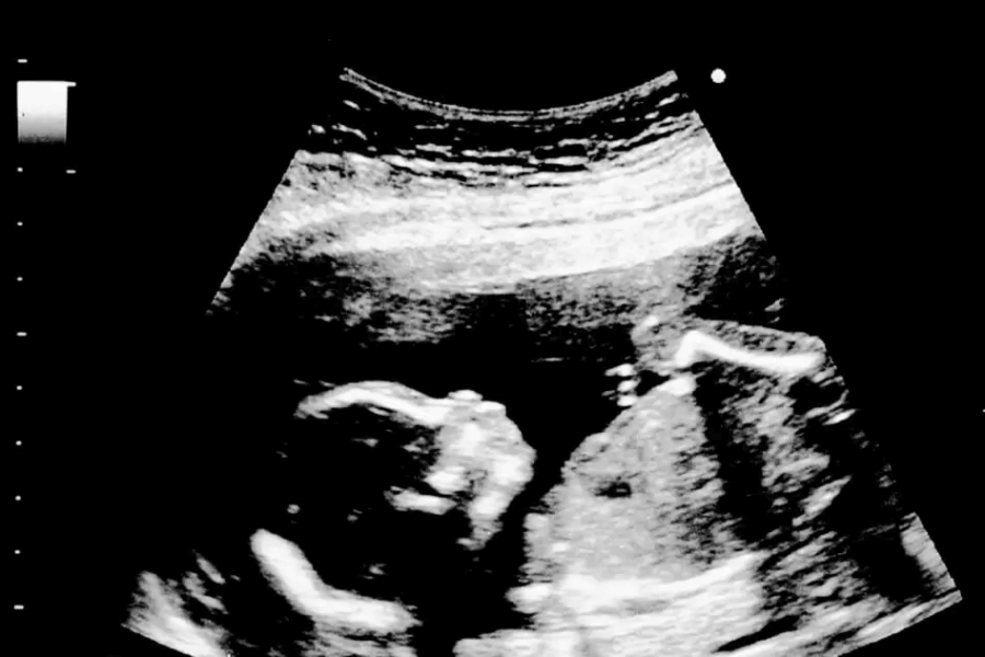 escolha do sexo do bebê